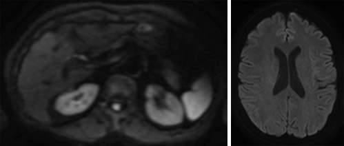 Diffusion Weighted Imaging (DWI)